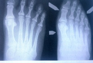 Radiografia aceluiasi picior descult in stanga si incaltat in pantof ascutit in dreapta. Se vede cum se deformeaza piciorul in halux valgus